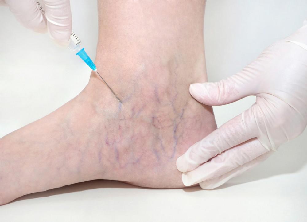 veins treatment